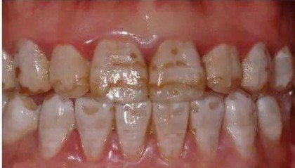 氟斑牙的治疗方法有几种